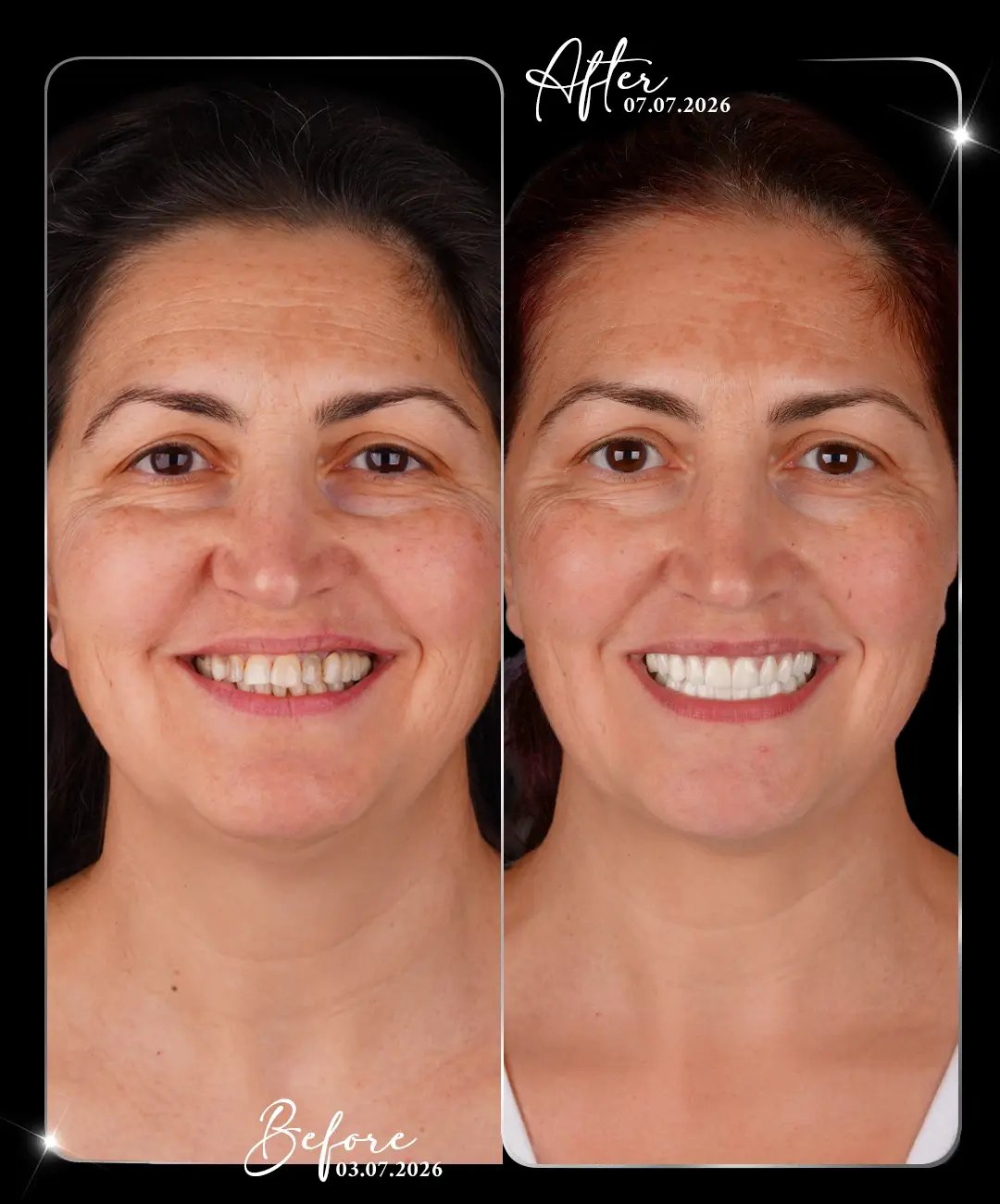 Hollywood-Smile-Before-After-4