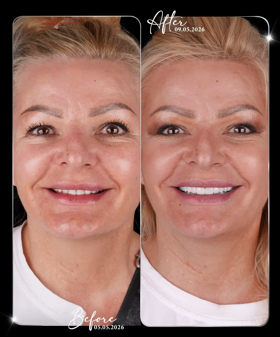 Hollywood-Smile-Before-After-5