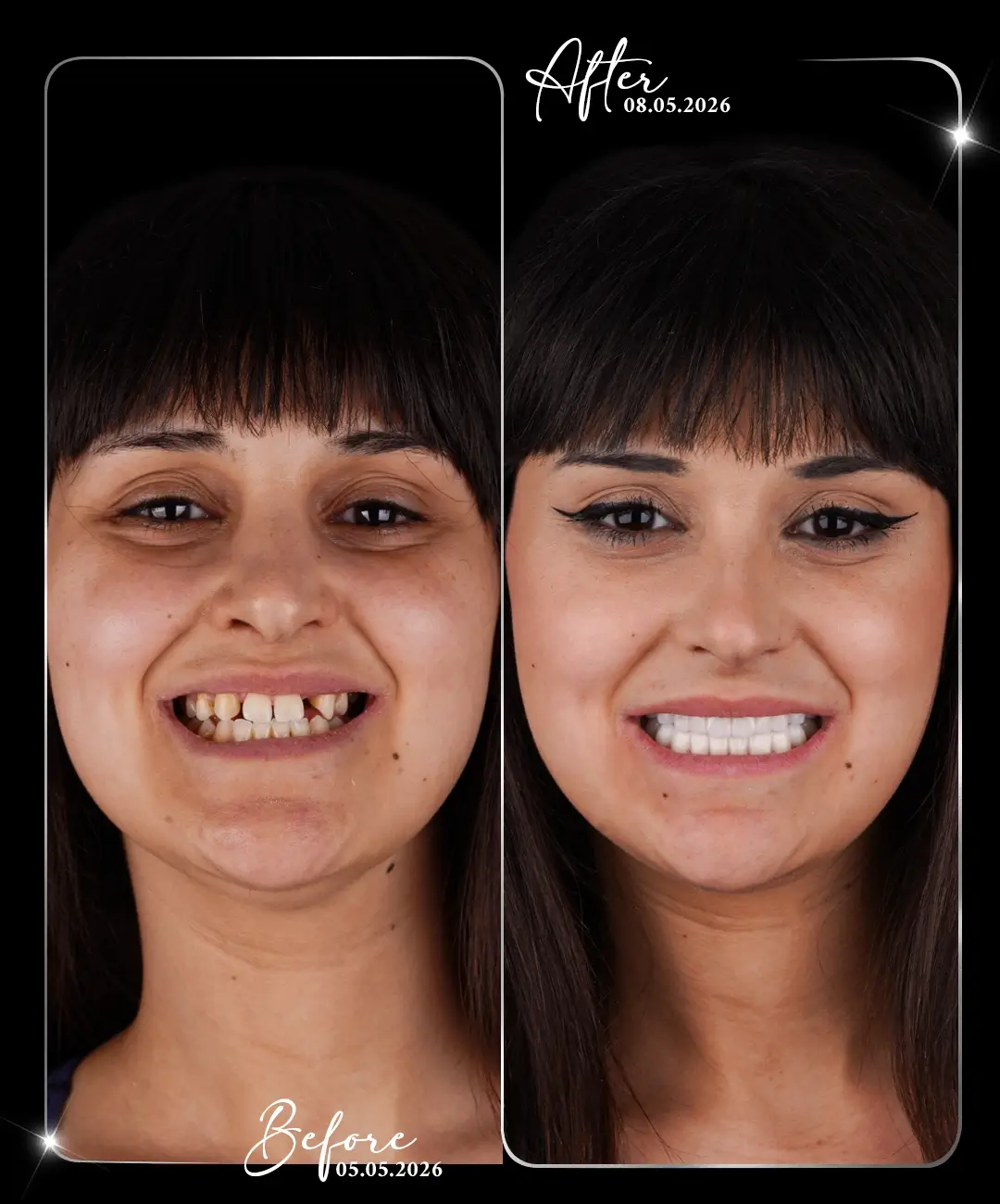 Hollywood-Smile-Before-After-6