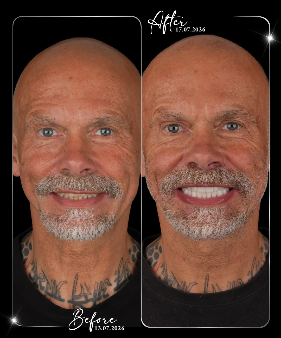 Hollywood-Smile-Before-After-7