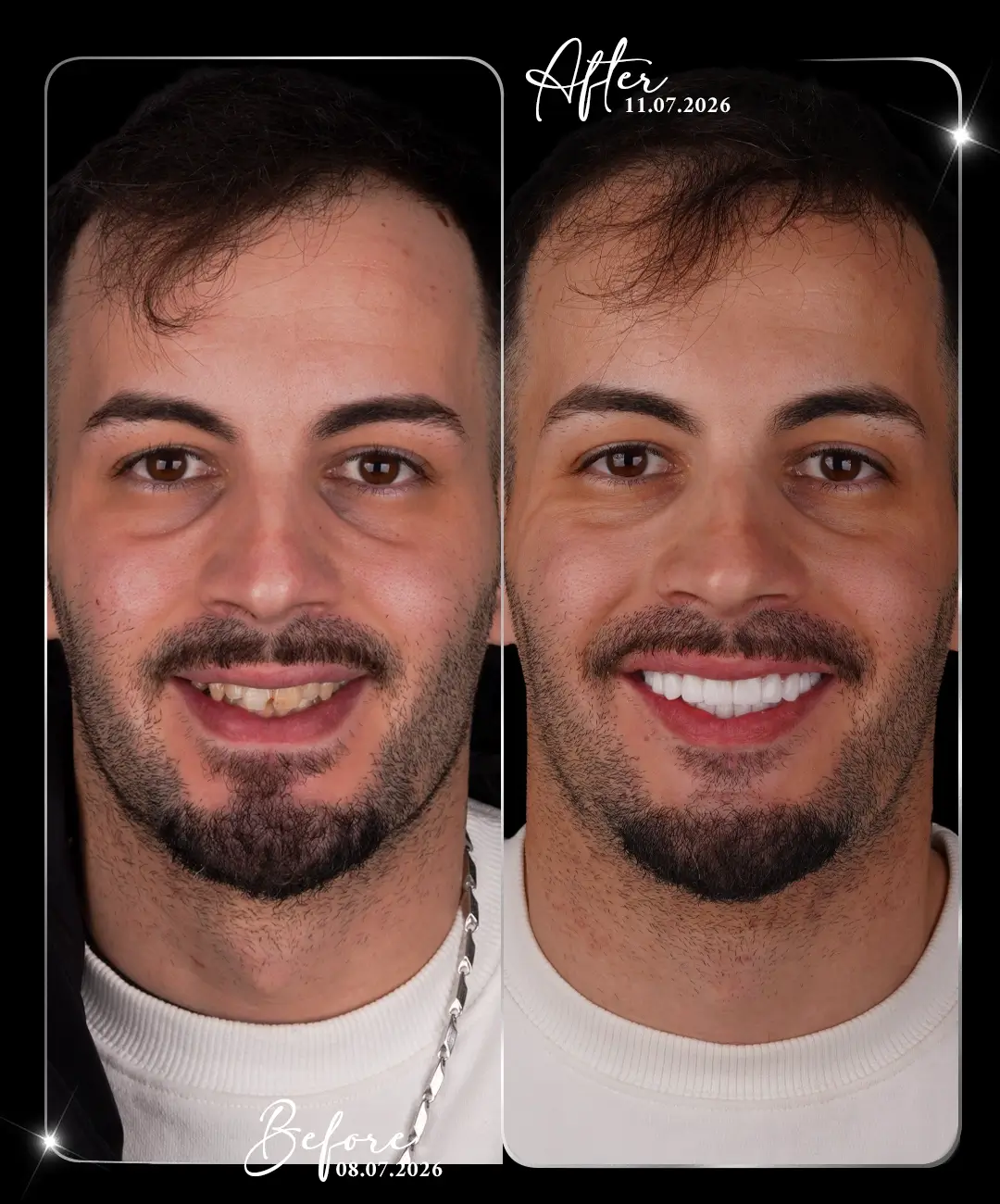 Hollywood-Smile-Before-After-8