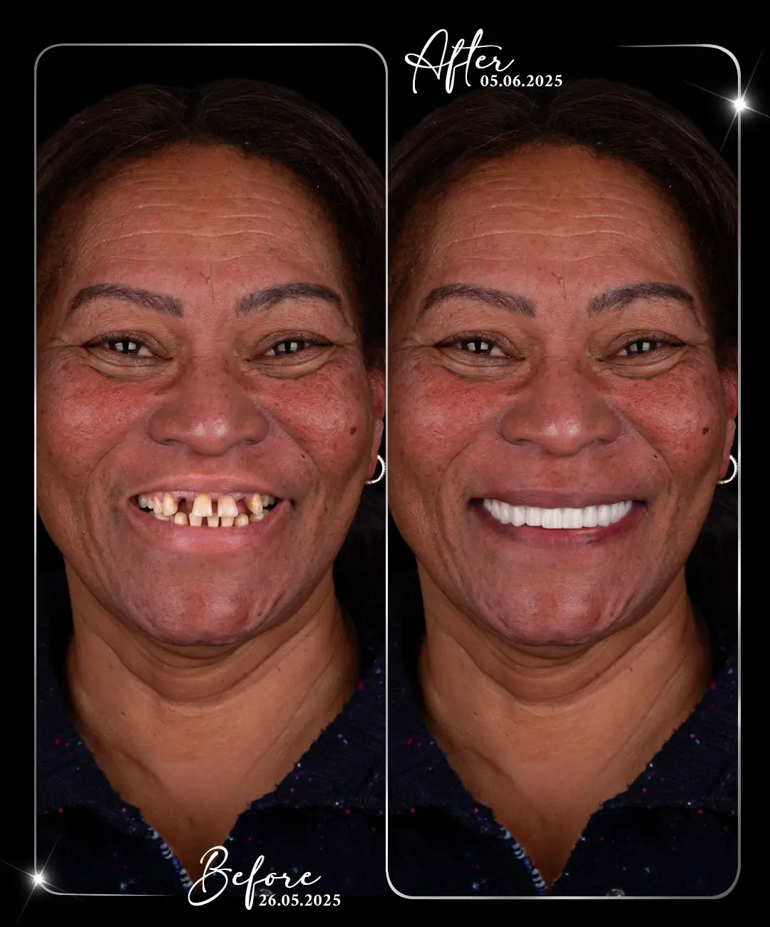 Hollywood-Smile-Before-After-9