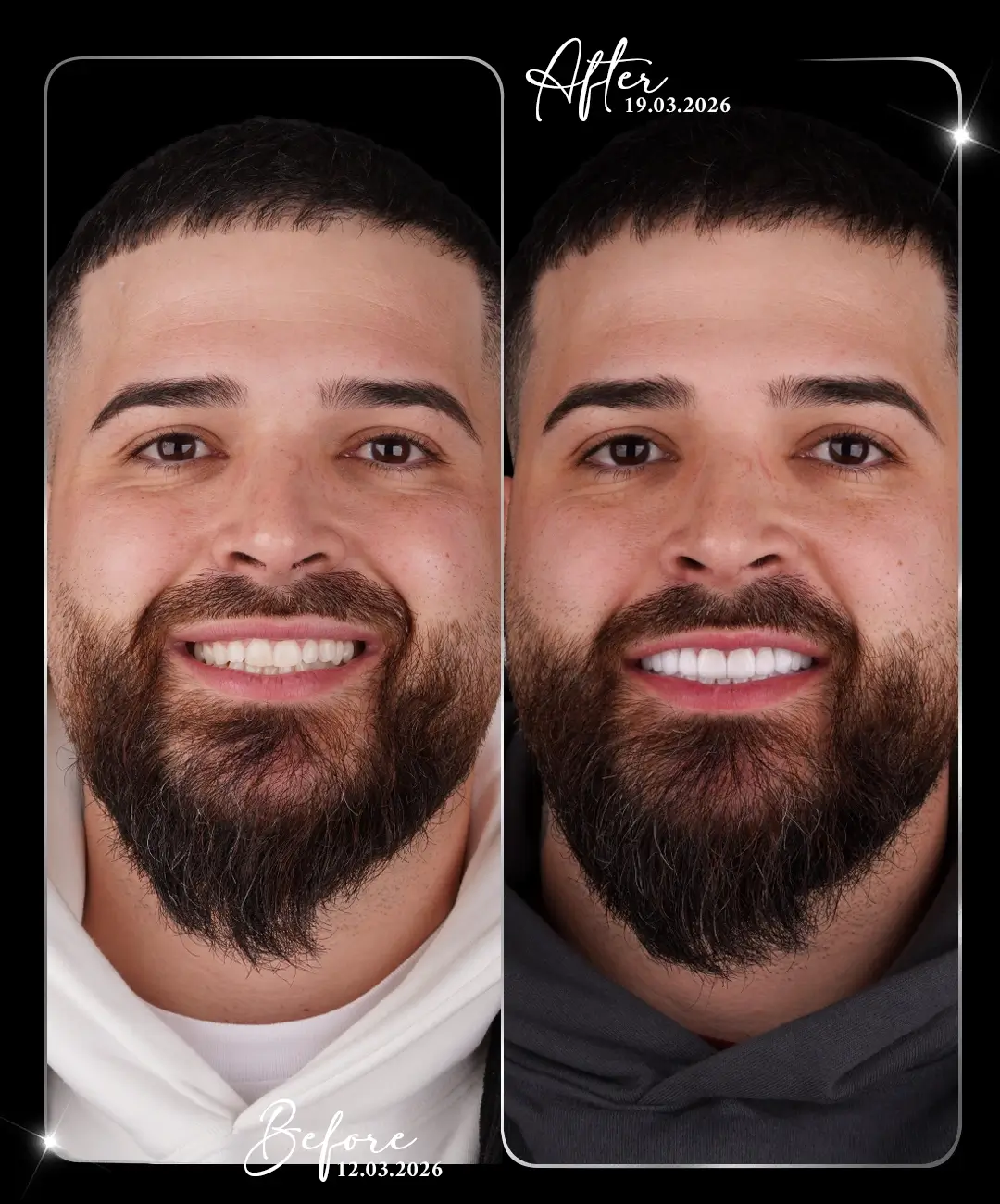 Lamine-Before-After-1
