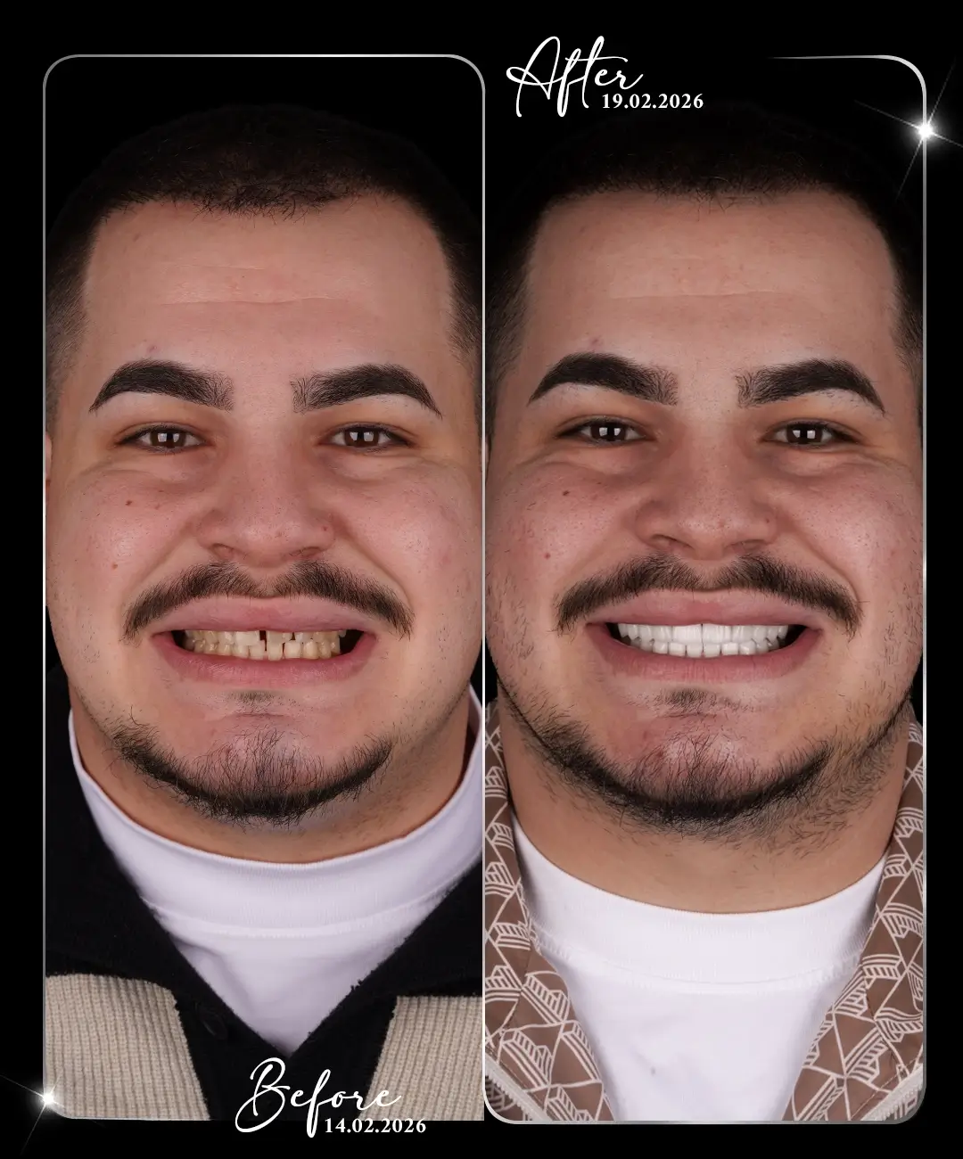 Lamine-Before-After-2