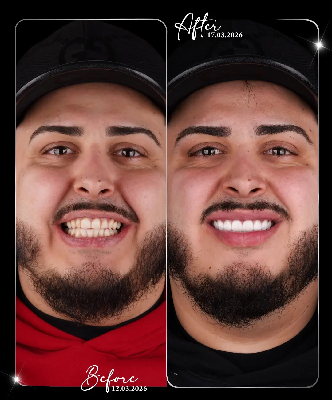 Lamine-Before-After-3