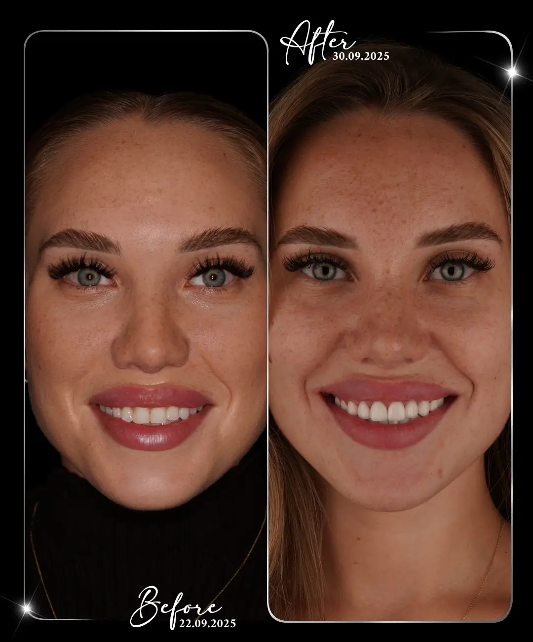 Lamine-Before-After-4