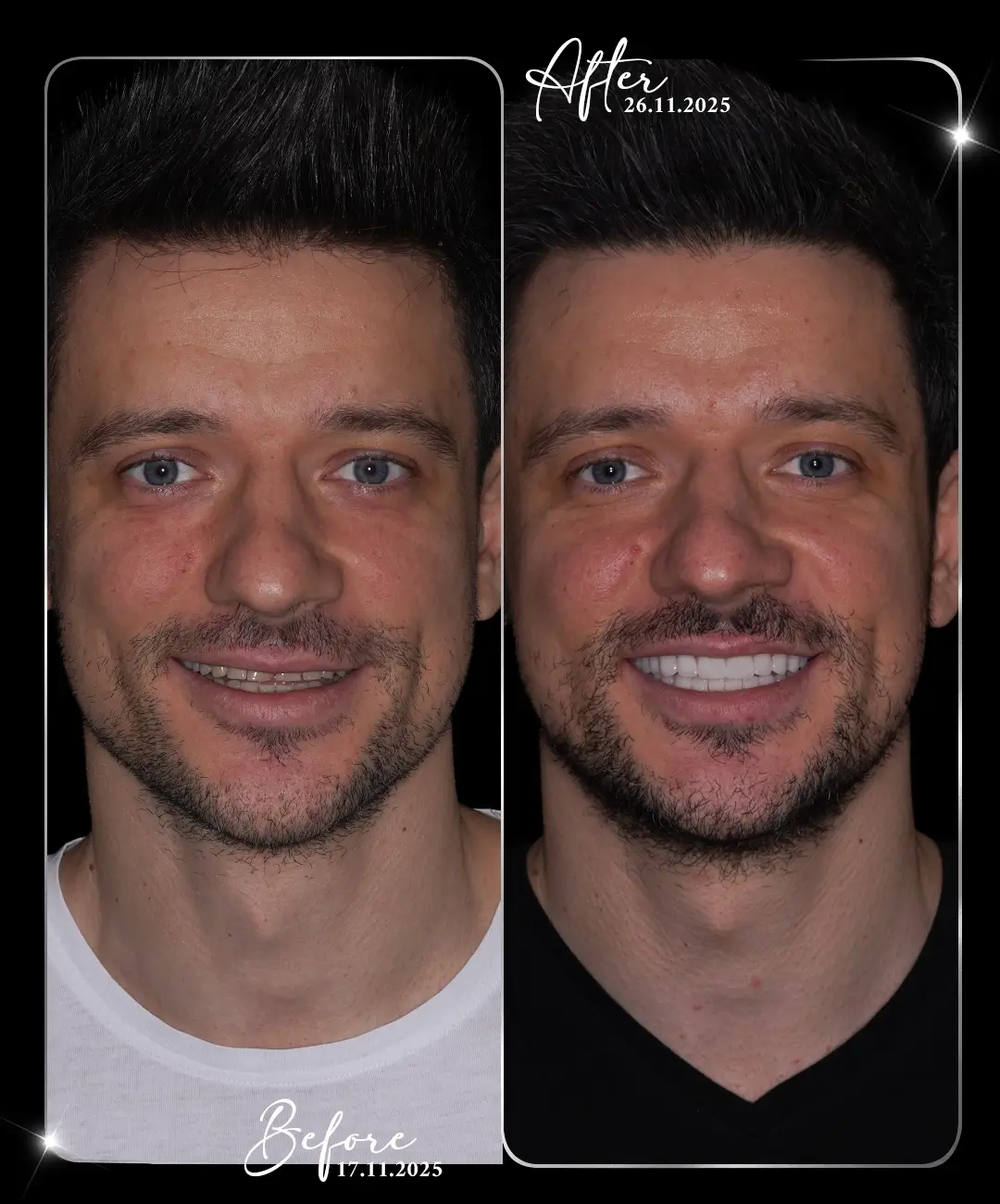 Lamine-Before-After-5