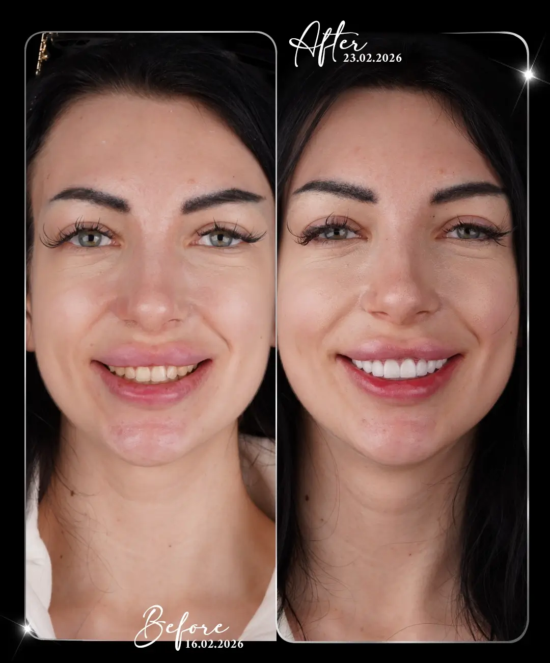 Lamine-Before-After-6