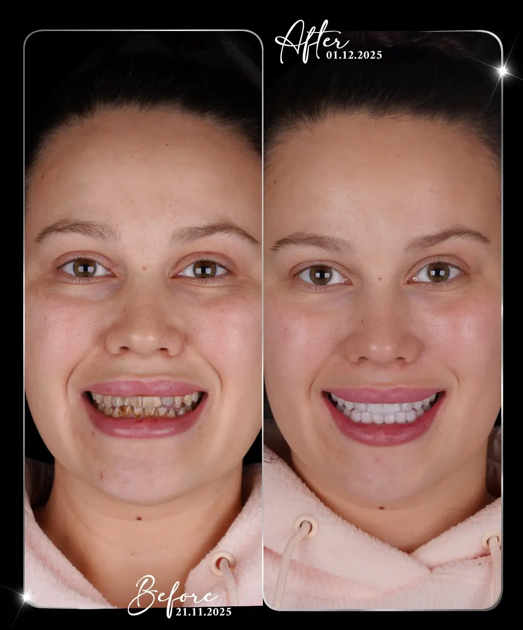 Lamine-Before-After-7