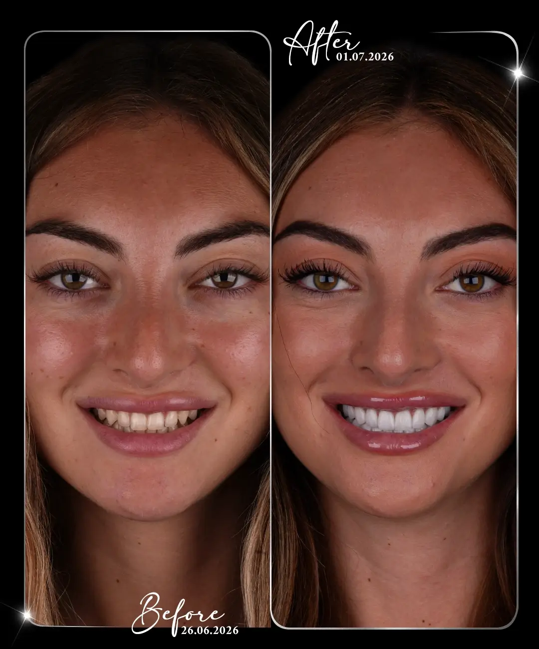 Lamine-Before-After-8