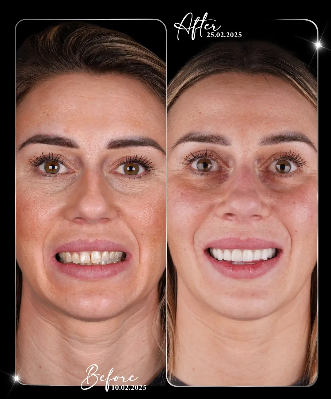 Lamine-Before-After-9