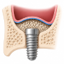 What is a sinus lift