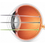 Trifocal IOL