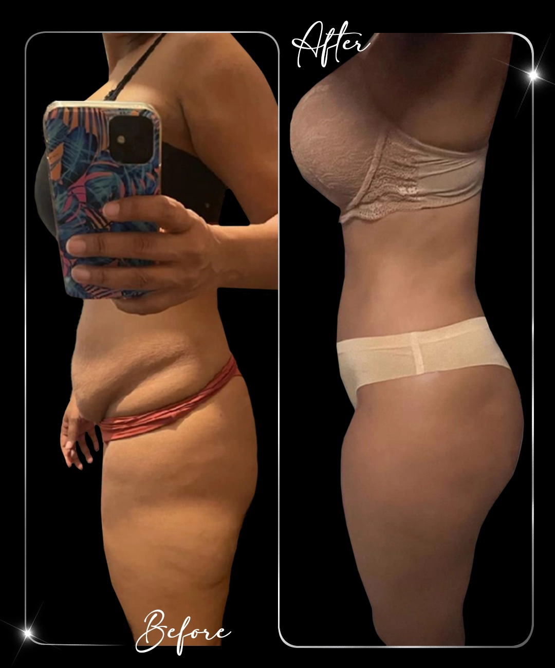 Tummy-Tuck-Before-After-1
