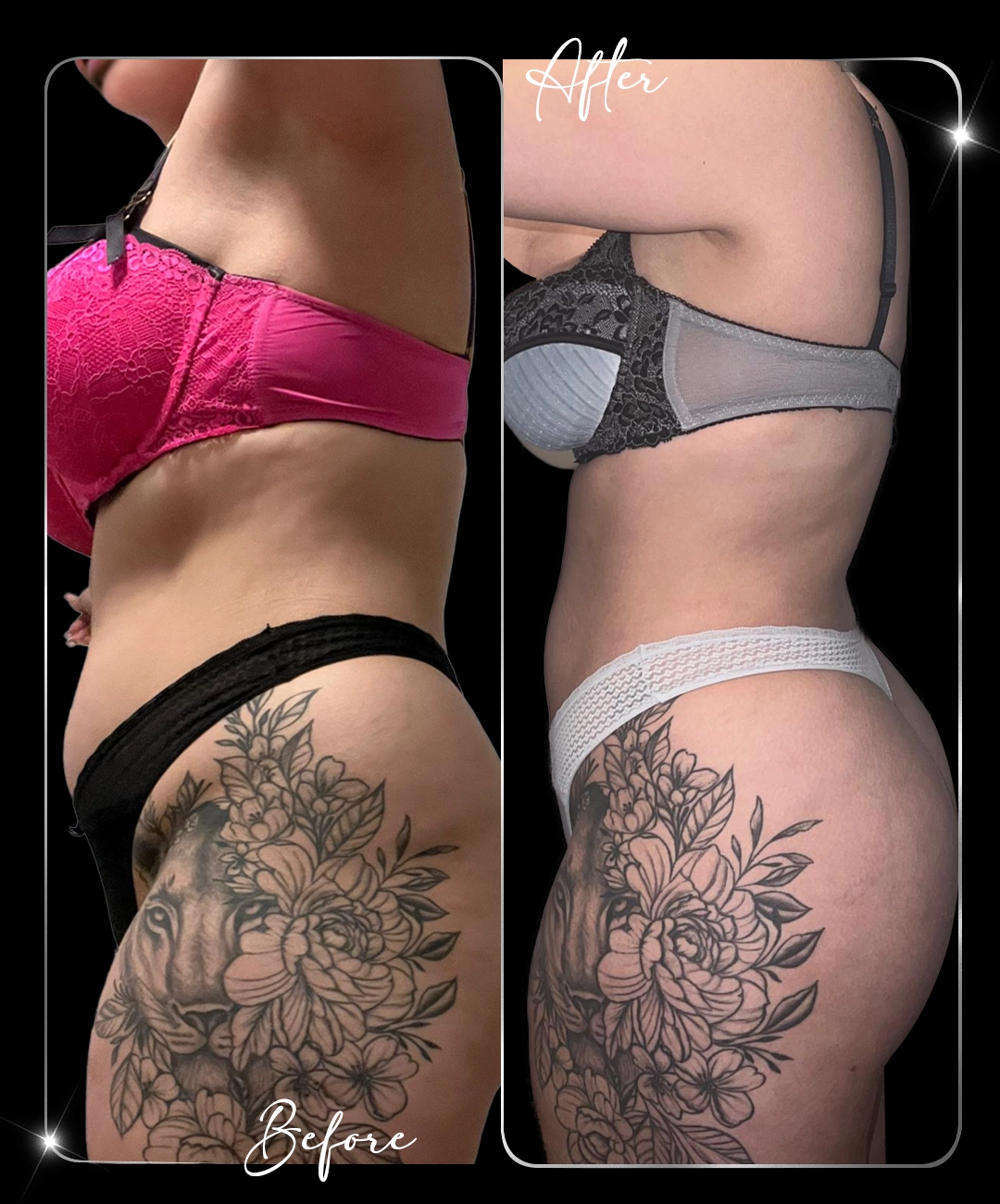 Tummy-Tuck-Before-After-2