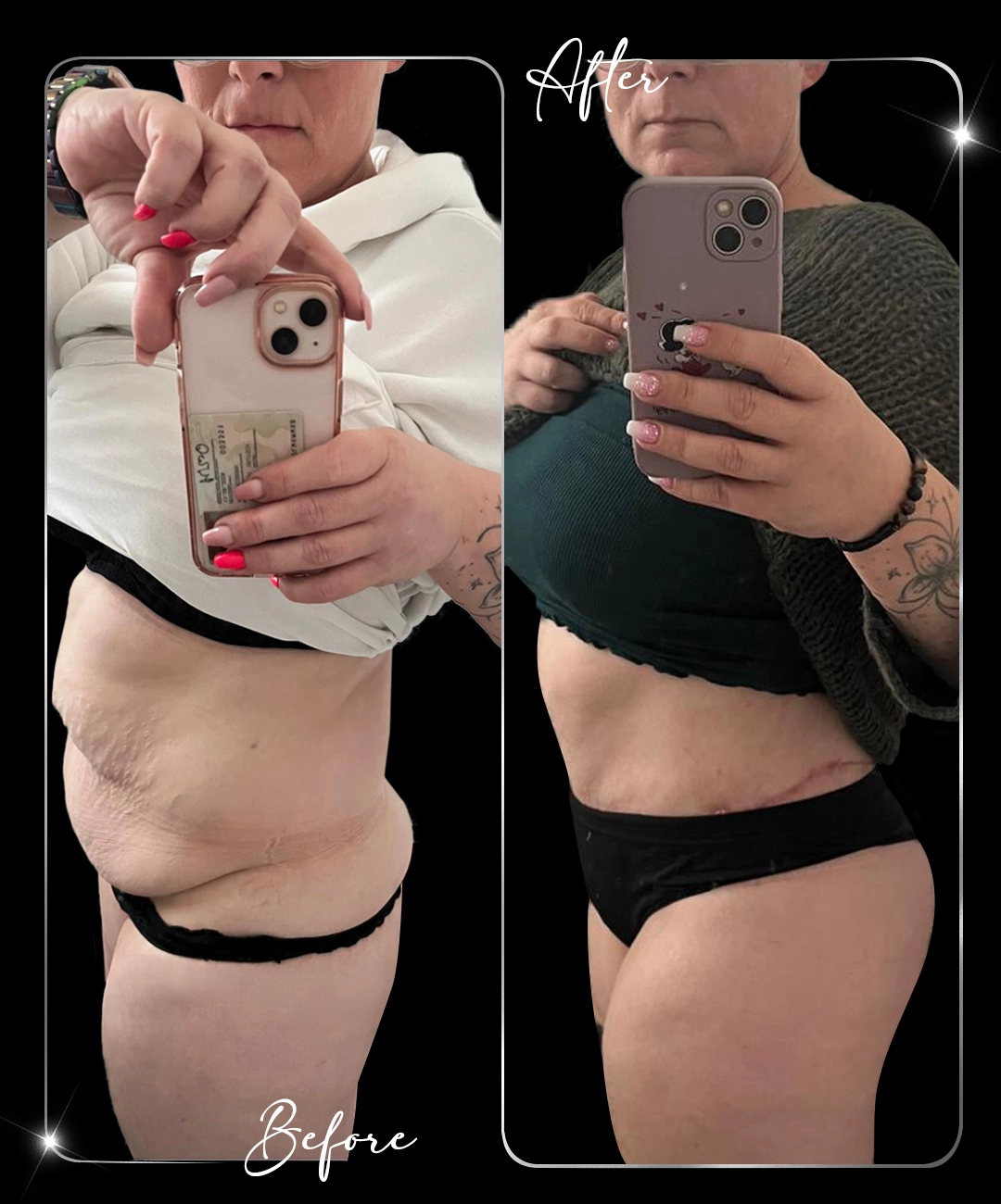Tummy-Tuck-Before-After-3