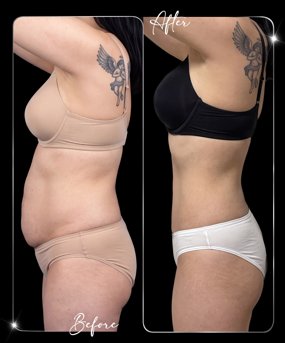 Tummy-Tuck-Before-After-4