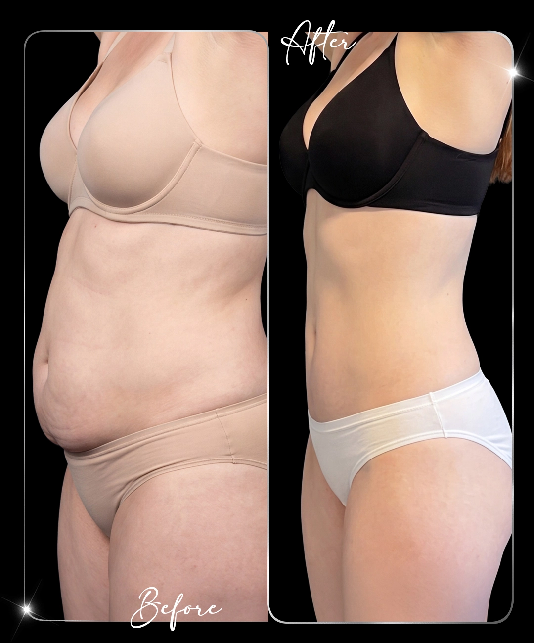 Tummy-Tuck-Before-After-5