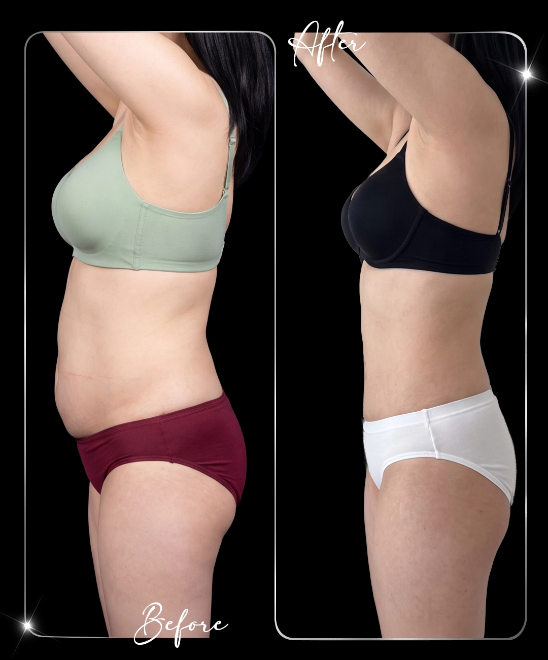 Tummy-Tuck-Before-After-6