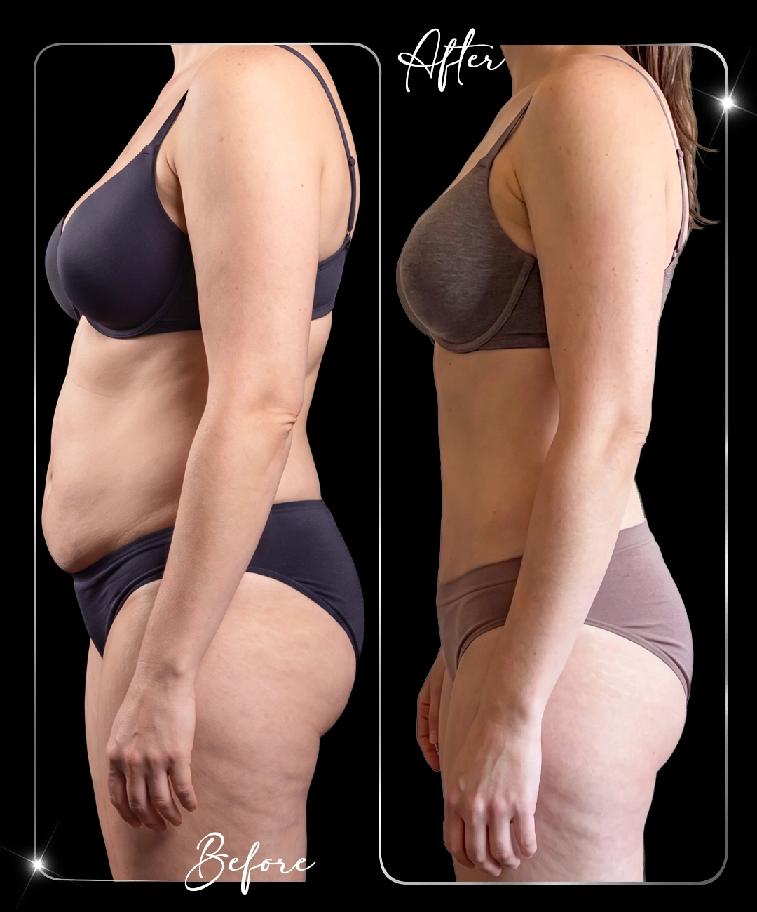 Tummy-Tuck-Before-After-7