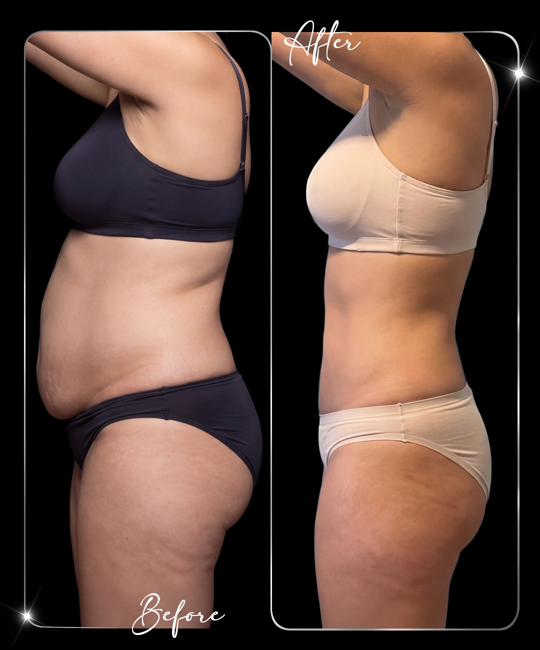 Tummy-Tuck-Before-After-8