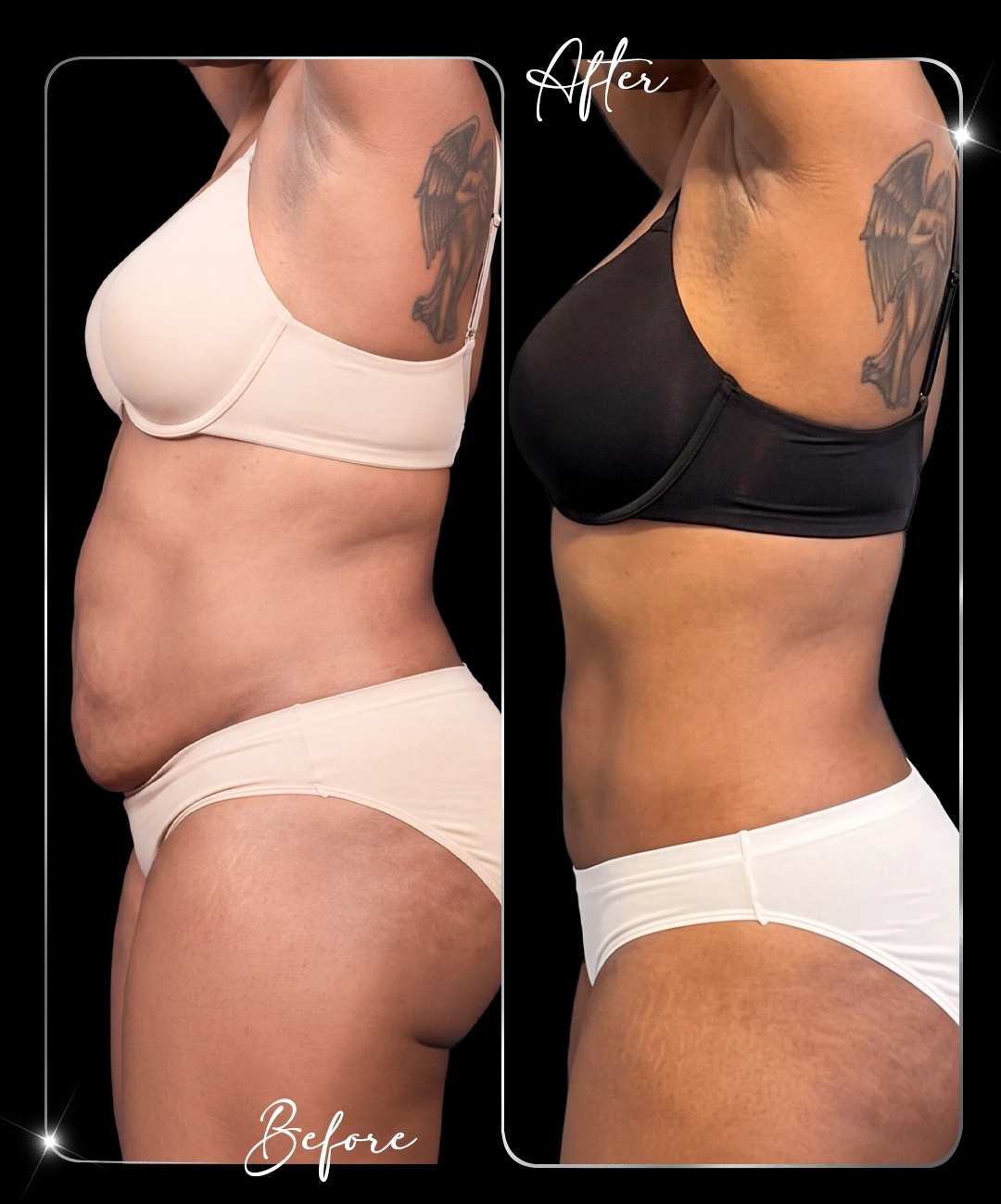 Tummy-Tuck-Before-After-9