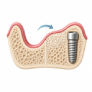What is a bone graft