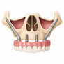 What is a Zygomatic Implant