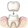 Zirconium Crown